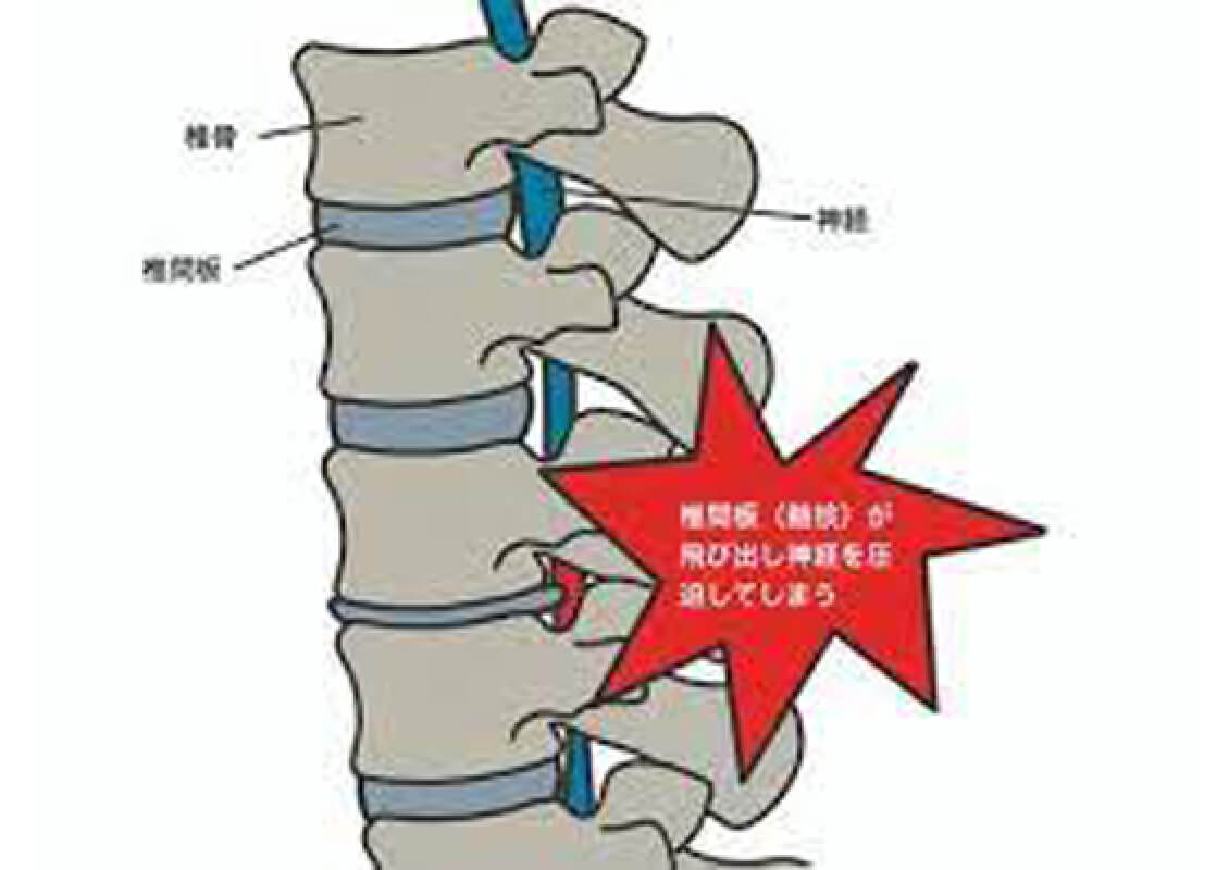 腰椎ヘルニア・頚椎ヘルニアの一般的な原因