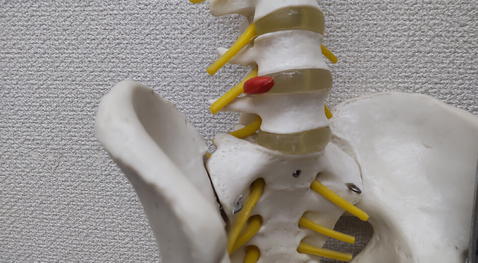 椎間板ヘルニア｜習志野市津田沼で手足の痺れの腰椎椎間板ヘルニア