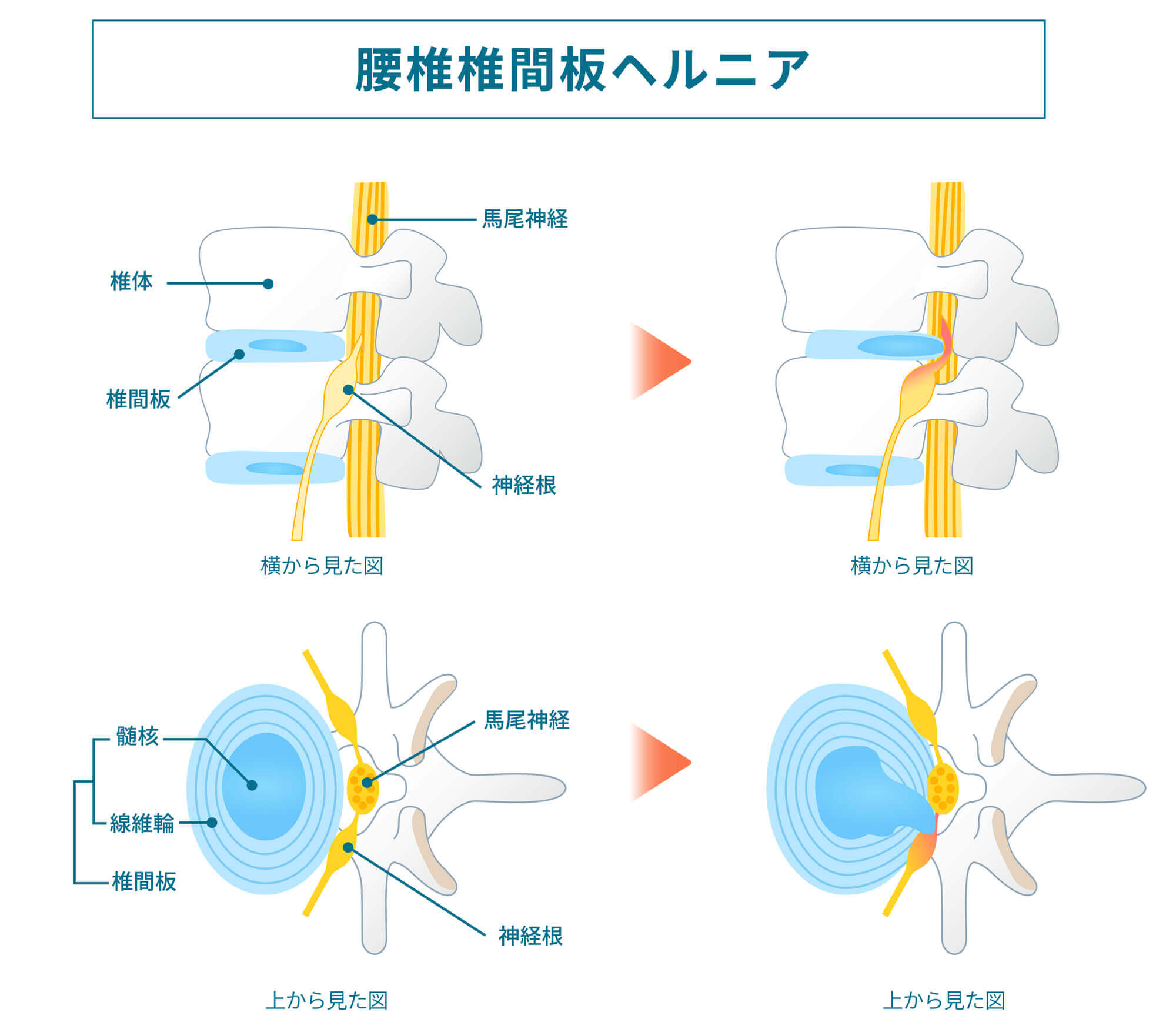 椎間板ヘルニア｜習志野市津田沼で手足の痺れの腰椎椎間板ヘルニア