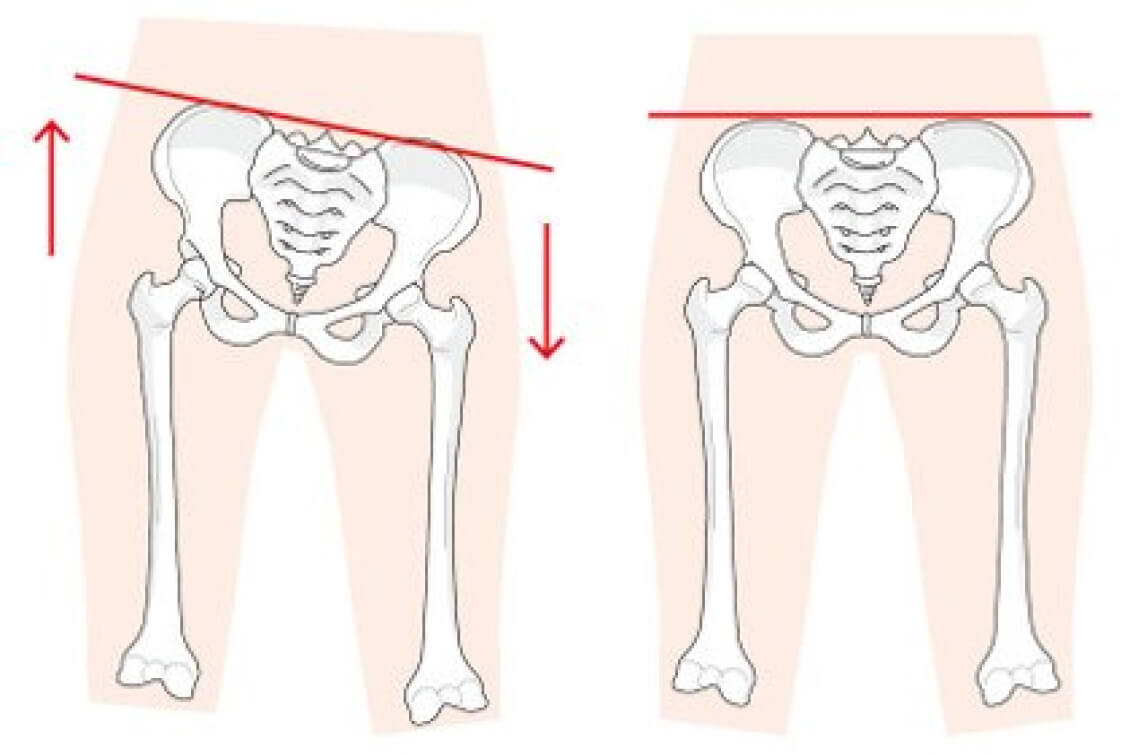 足の長さによる膝痛の原因