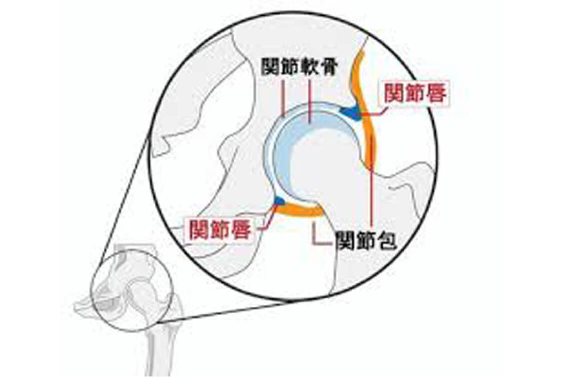 股関節痛の状態の人体図