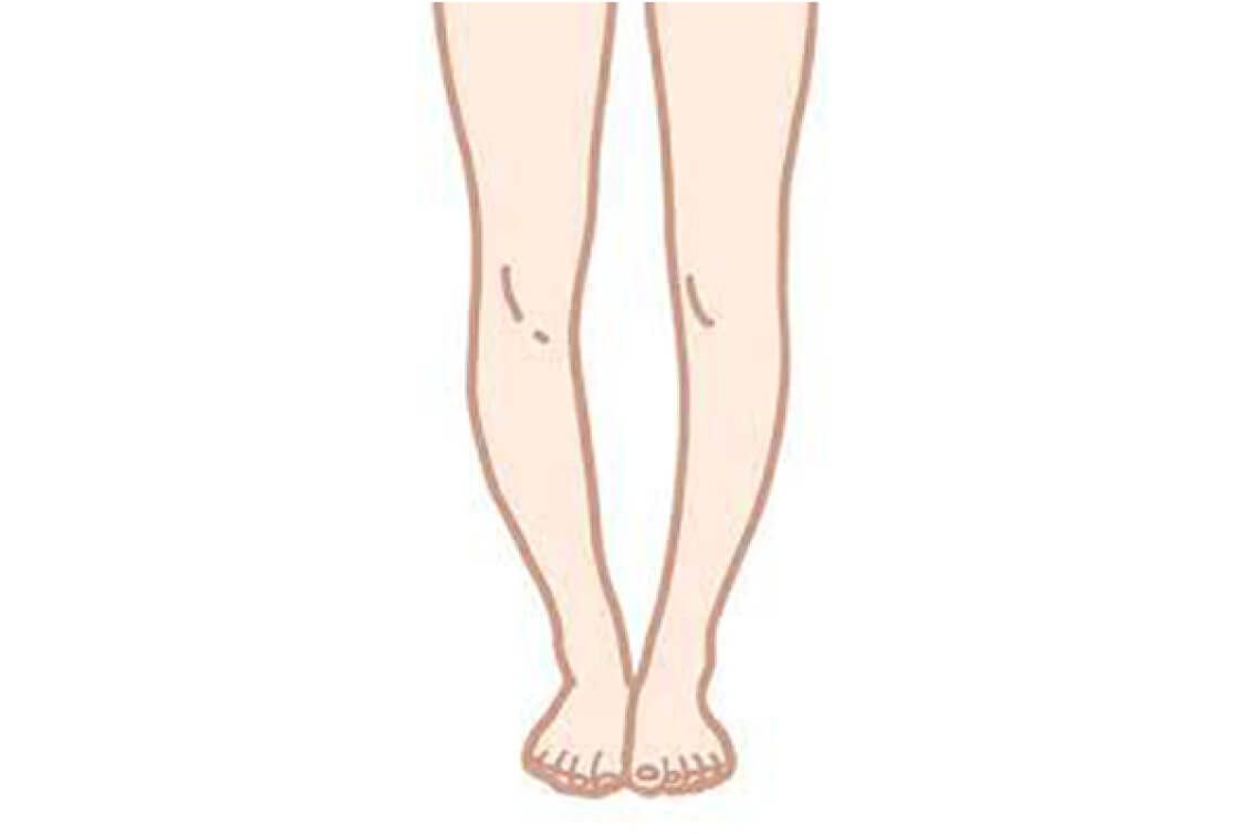 O脚矯正の一般的な原因