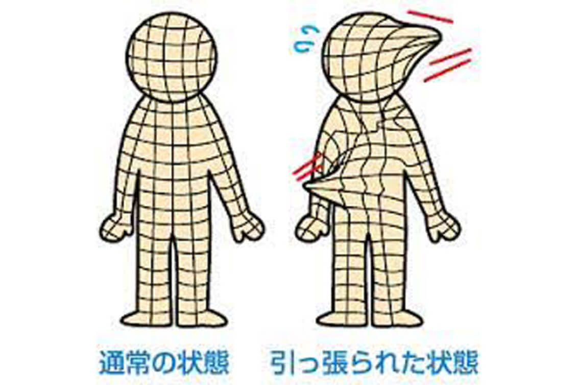 テニス以外でのテニス肘の原因