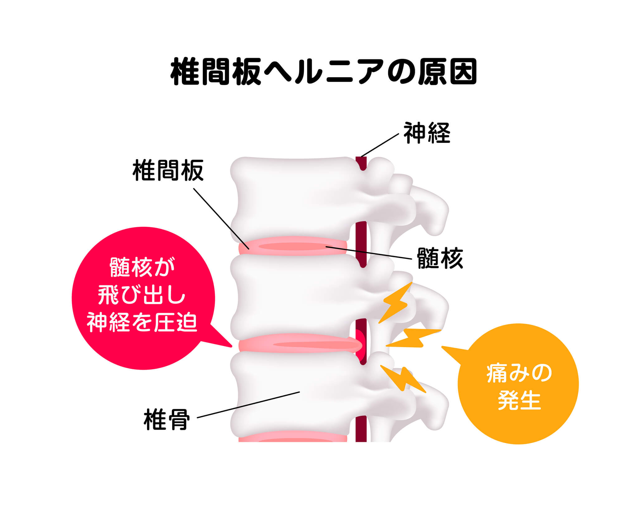 頚椎椎間板ヘルニアを発症する主な原因と生活習慣