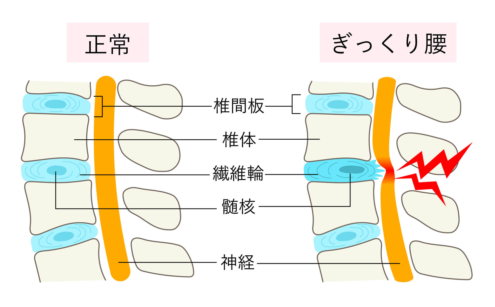ぎっくり腰(急性腰痛症)とは