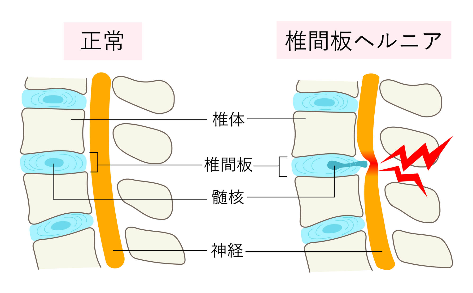 椎間板ヘルニアとは
